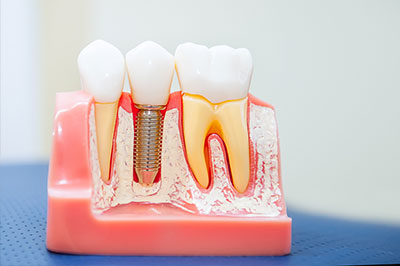 Ripon Plaza Dental   Escalon Family Dental | Invisalign reg , Night Guards and Emergency Treatment