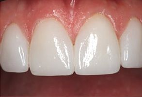 Ripon Plaza Dental   Escalon Family Dental | Dental Bridges, Veneers and Digital Impressions
